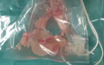 Hãi hùng ổ sán khổng lồ trú ngụ trong não người đàn ông