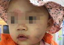 Bé gái 14 tháng tuổi bị thương sau giờ học ở lớp mầm non do bạn cắn