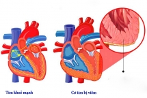 bo y te khang dinh khong co virus viem co tim