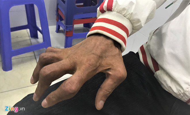 Dùng thuốc chữa vảy nến chứa corticoid, người đàn ông bị tàn phế