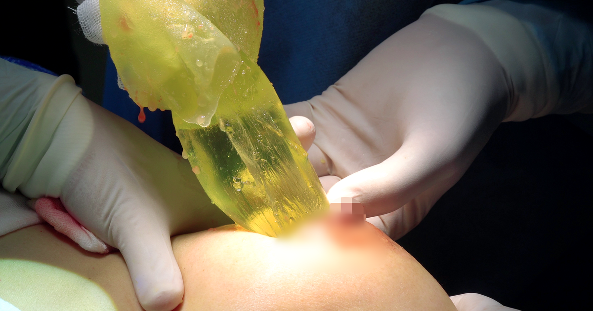 Vỡ túi ngực, silicon tràn ra như… “đầm lầy”