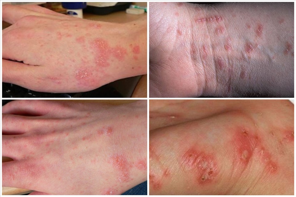 Những điều quan trọng cần biết để phòng tránh bệnh da liễu mùa lũ