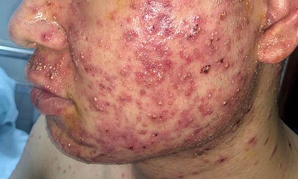 Nổi mụn chi chít do uống thuốc trôi nổi