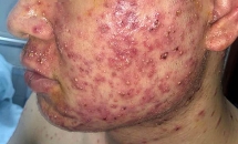 Nổi mụn chi chít do uống thuốc trôi nổi