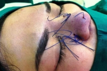 Bác sĩ Da liễu thẩm mỹ: Căng chỉ làm đẹp 3 triệu đồng, chị em dễ rơi vào "bẫy giá rẻ"