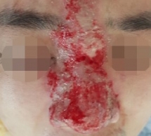 Nhiều người bị hoại tử da, giảm thị lực vì tiêm filler nâng mũi tại spa