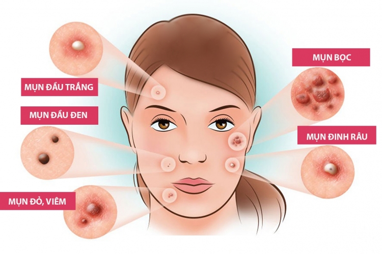 Bác sĩ da liễu chỉ ra 3 sai lầm về cậy - nặn mụn trứng cá