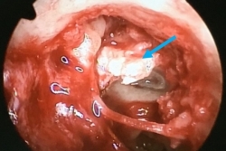 U biểu bì lạc chỗ, bé gái 13 tuổi bất ngờ bị điếc