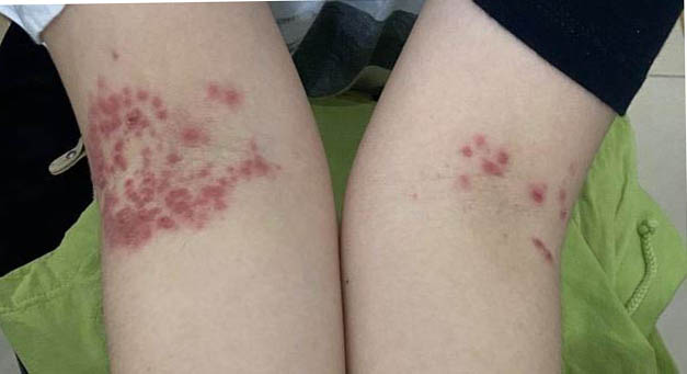 Một phụ nữ 32 tuổi mắc bệnh tay chân miệng