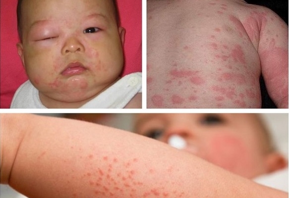 Xử trí khi trẻ dị ứng thời tiết