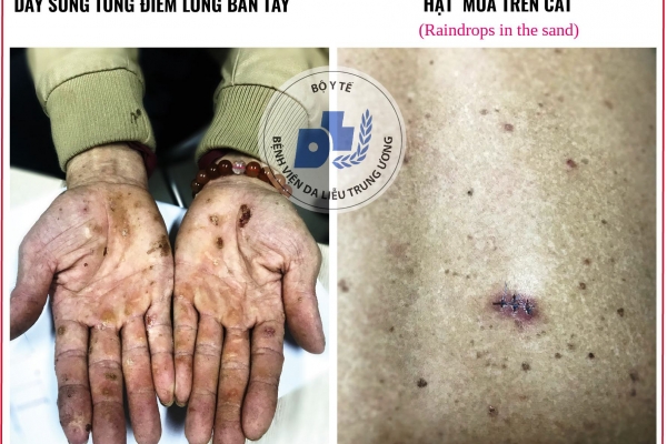 Cảnh báo nhiễm độc thạch tín gây ung thư da mà không hề hay biết