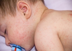 Số ca nhiễm sởi gia tăng do nhiều trẻ em không được tiêm phòng vì Covid-19