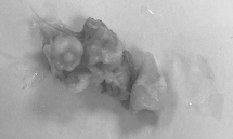 5 chiếc răng mọc trong khối u