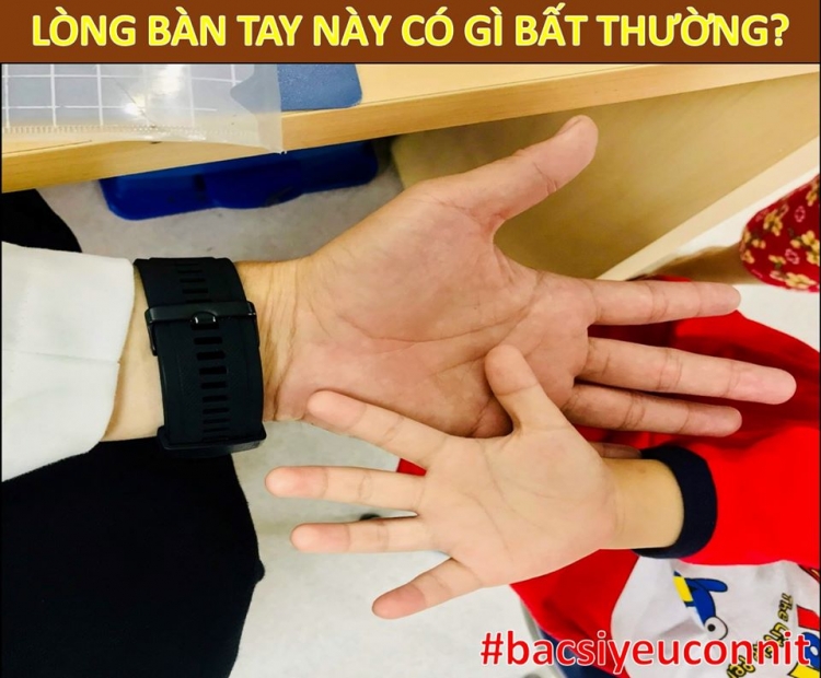 uong qua nhieu sua bo tre bi thieu mau thieu sat