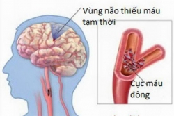 Xoa bóp, bấm huyệt trị liệu chứng trúng phong