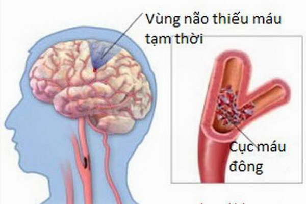 Xoa bóp, bấm huyệt trị liệu chứng trúng phong