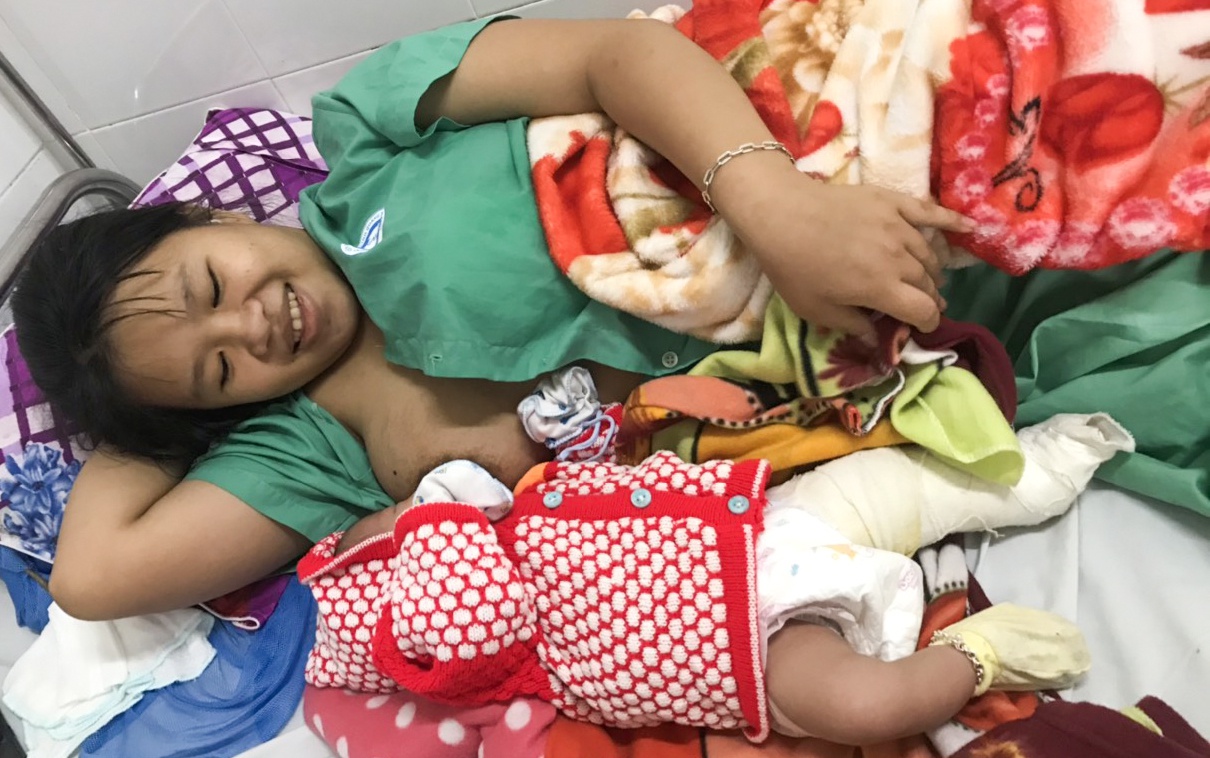 Bé trai gãy xương đùi khi sinh mổ