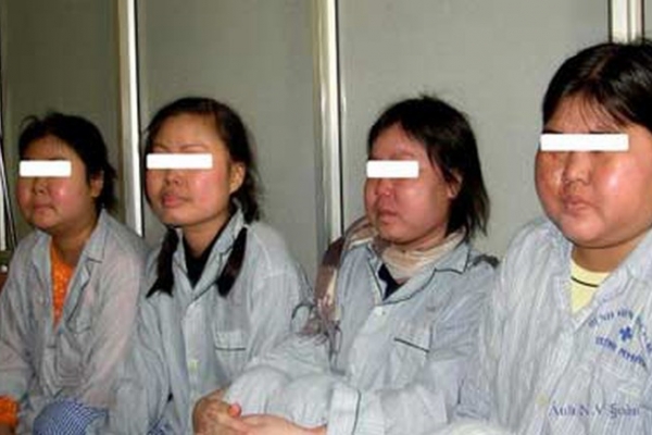 Mặt to bất thường sau khi dùng thuốc Đông y trị bệnh khớp