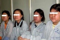 Mặt to bất thường sau khi dùng thuốc Đông y trị bệnh khớp