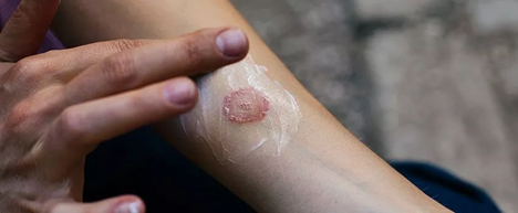 Nấm da bùng phát do nồm ẩm, điều trị như thế nào?