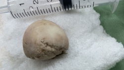 Ăn trứng vịt lộn, người đàn ông phải vào viện cấp cứu