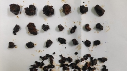 Yên Bái: Người phụ nữ 30 tuổi mang trong mình 100 viên sỏi đường mật