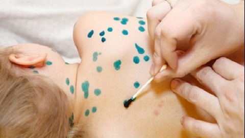 Ca mắc thuỷ đậu tăng cao, làm gì để phòng tránh?