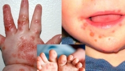 nhieu tre mac tay chan mieng nang bien chung nguy hiem