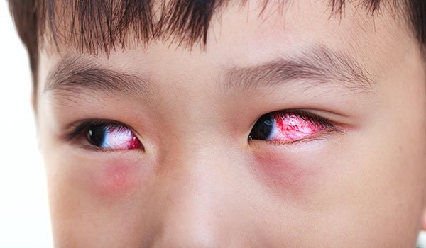 Triệu chứng mắc COVID-19 mới: Đau mắt đỏ!