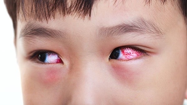 Triệu chứng mắc COVID-19 mới: Đau mắt đỏ!