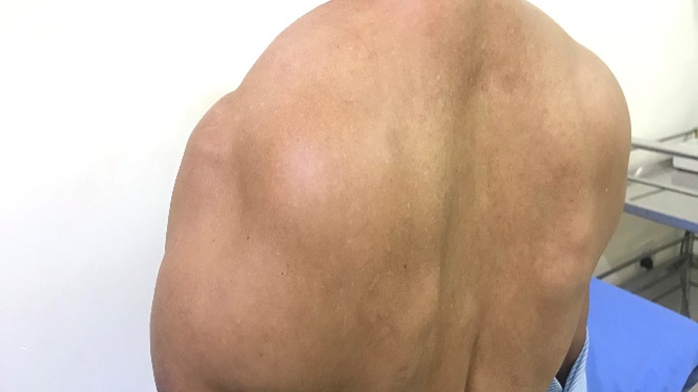 Hi hữu người đàn ông Bắc Giang mắc bệnh "người gấu"