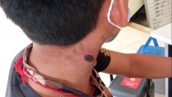 Điện Biên: Phát hiện ca thứ 14 mắc bệnh than, không rõ nguồn lây